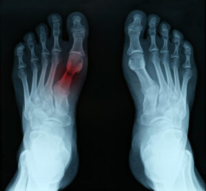radiografía del pie