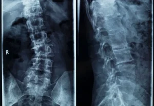 radiografia columna vertebral escoliosis