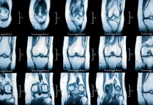 radiografias menisco de rodilla